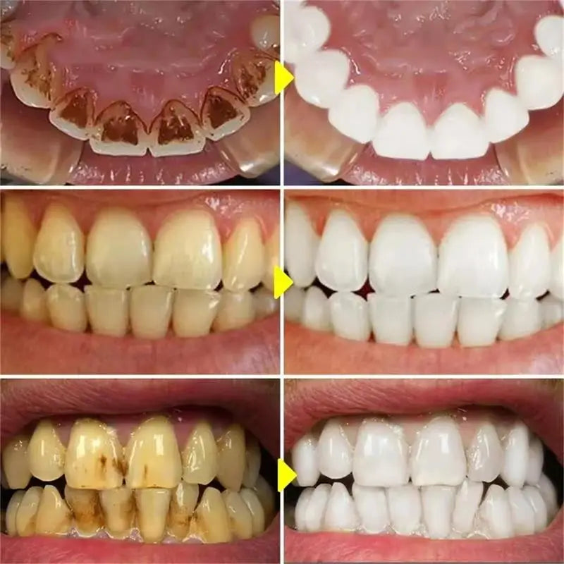 Teeth Whitening Pen with One, Three or Five-Piece Pack Options and Source Gel References for Label-Guided Adult Cosmetic Oral Care Selection