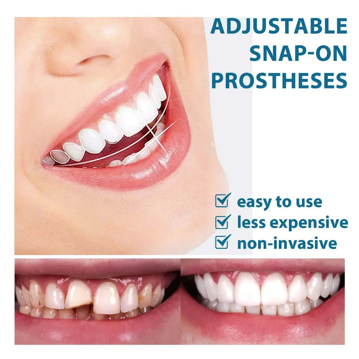 Adjustable Snap-On Teeth Kit with One-, Three- or Five-Box Option Labels for Cosmetic Appearance Consideration, with Dental Suitability and Fit Requiring Review