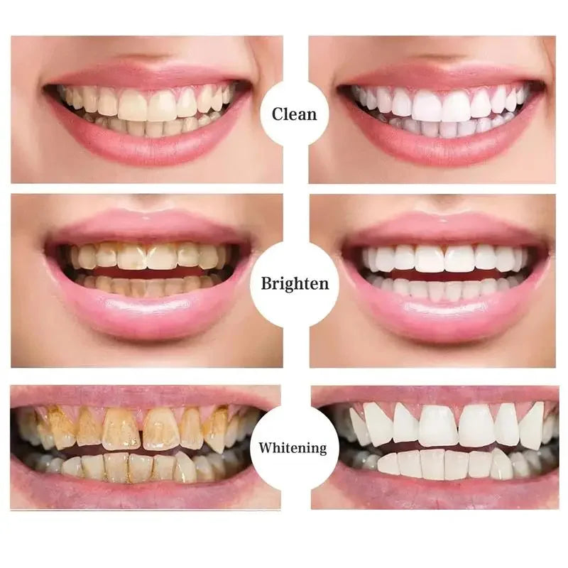 Teeth Whitening Pen with One, Three or Five-Piece Pack Options and Source Gel References for Label-Guided Adult Cosmetic Oral Care Selection