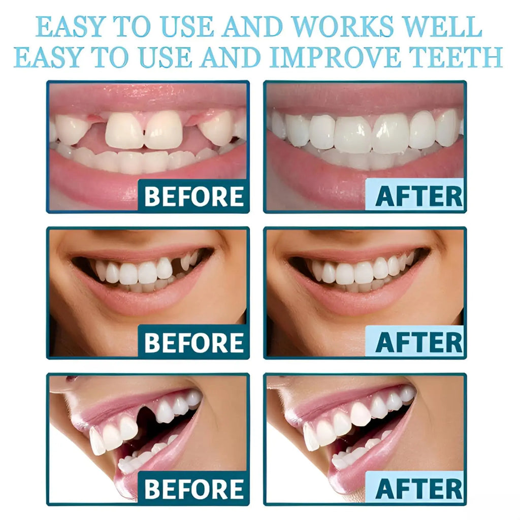 Adjustable Snap-On Teeth Kit with One-, Three- or Five-Box Option Labels for Cosmetic Appearance Consideration, with Dental Suitability and Fit Requiring Review