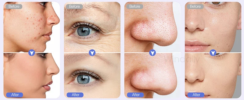 Cordless Diamond Microdermabrasion Device with Replaceable Tip References, Nine-Head Five-Level or Four-Head Three-Level Options for Adult Facial Beauty Routines