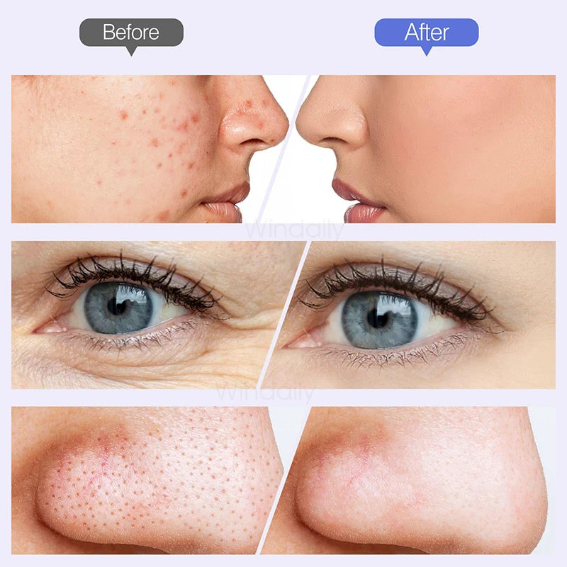 Cordless Diamond Microdermabrasion Device with Replaceable Tip References, Nine-Head Five-Level or Four-Head Three-Level Options for Adult Facial Beauty Routines