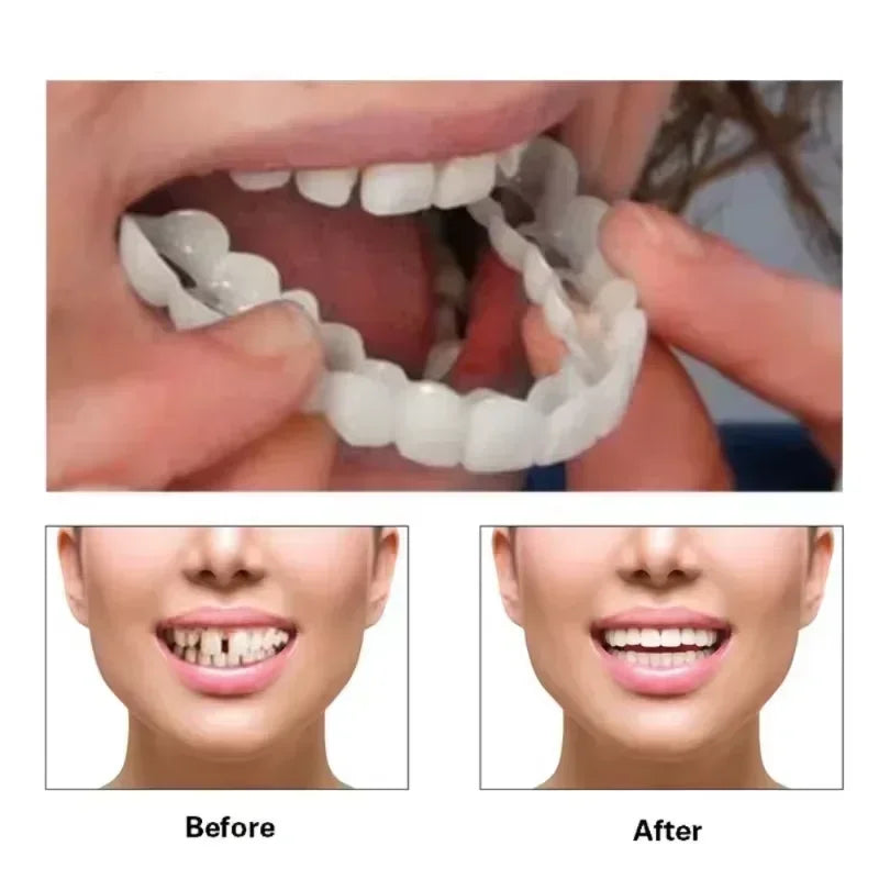 Silicone Denture-Style Teeth Covers with Single-Piece and Bundle Purchase Labels, Temporary Simulated-Teeth Appearance Reference Requiring Professional Fit Review