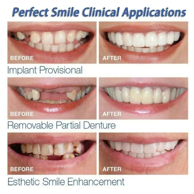 Silicone Denture-Style Teeth Covers with Single-Piece and Bundle Purchase Labels, Temporary Simulated-Teeth Appearance Reference Requiring Professional Fit Review