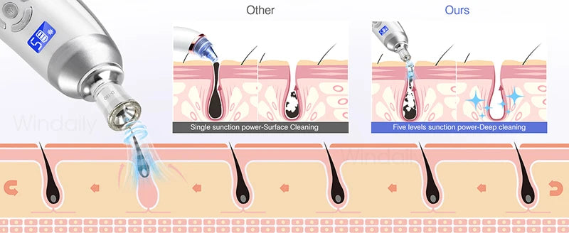Cordless Diamond Microdermabrasion Device with Replaceable Tip References, Nine-Head Five-Level or Four-Head Three-Level Options for Adult Facial Beauty Routines